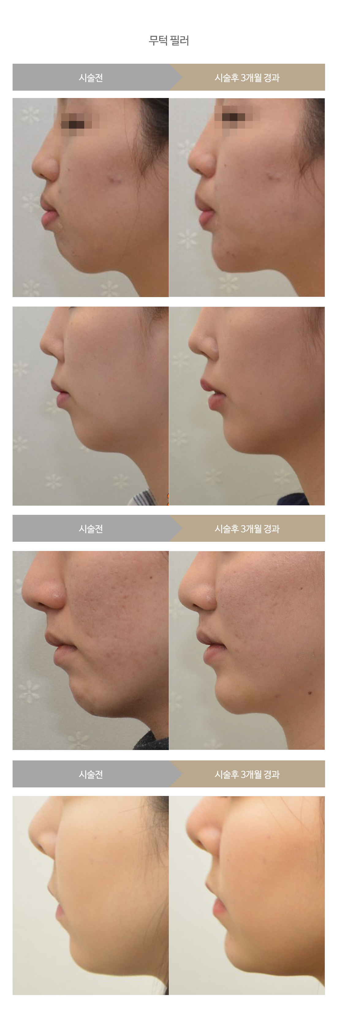 전후사진